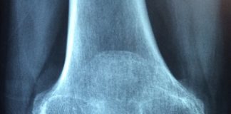 Dieta przy reumatyzmie