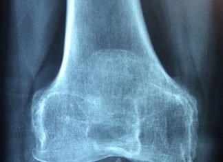 Dieta przy reumatyzmie