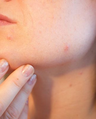 Depilacja laserowa – opis zabiegu Depilacja laserowa - opis zabiegu